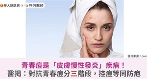 青春痘是「皮膚慢性發炎」疾病！醫揭：對抗青春痘分三階段，控痘等同防疤