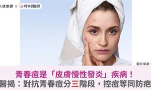 青春痘是「皮膚慢性發炎」疾病！醫揭：對抗青春痘分三階段，控痘等同防疤
