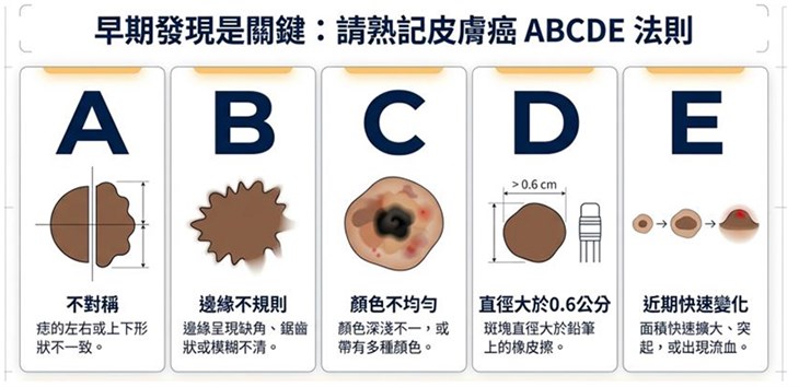 皮膚癌ABCDE法則(圖表提供/臺北榮總醫院)