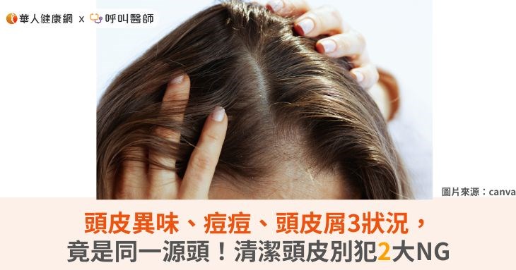 頭皮異味、痘痘、頭皮屑3狀況,竟是同一源頭!清潔頭皮別犯2大NG