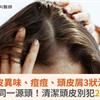 頭皮異味、痘痘、頭皮屑3狀況，竟是同一源頭！清潔頭皮別犯2大NG