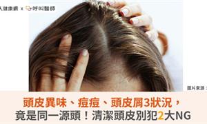 頭皮異味、痘痘、頭皮屑3狀況，竟是同一源頭！清潔頭皮別犯2大NG