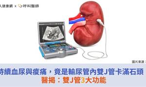 持續血尿與痠痛,竟是輸尿管內雙J管卡滿石頭!醫揭:雙J管3大功能