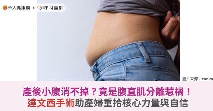 產後小腹消不掉?竟是腹直肌分離惹禍!達文西手術助產婦重拾核心力量與自信