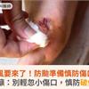 巴威颱風要來了！防颱準備慎防傷口感染 ！醫籲：別輕忽小傷口，慎防破傷風 