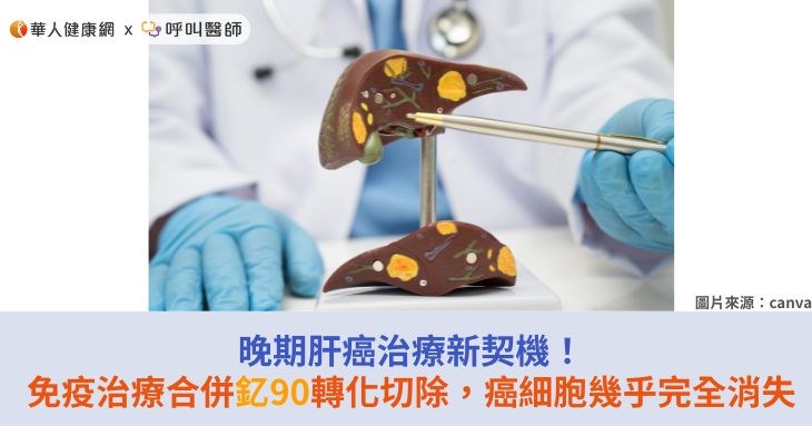 晚期肝癌治療新契機!免疫治療合併釔90轉化切除,癌細胞幾乎完全消失