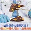 晚期肝癌治療新契機！免疫治療合併釔90轉化切除，癌細胞幾乎完全消失