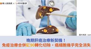 晚期肝癌治療新契機！免疫治療合併釔90轉化切除，癌細胞幾乎完全消失