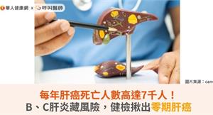 每年肝癌死亡人數高達7千人！B、C肝炎藏風險，健檢揪出零期肝癌