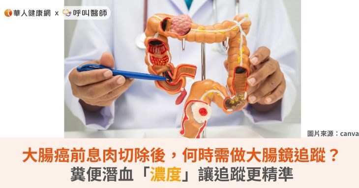 大腸癌前息肉切除後,何時需做大腸鏡追蹤?糞便潛血「濃度」讓追蹤更精準