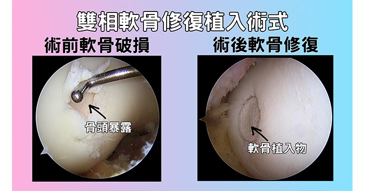雙相軟骨修復植入術式(圖表提供/中國醫藥大學新竹附設醫院)