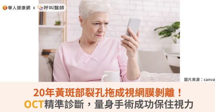 20年黃斑部裂孔拖成視網膜剝離!OCT精準診斷,量身手術成功保住視力