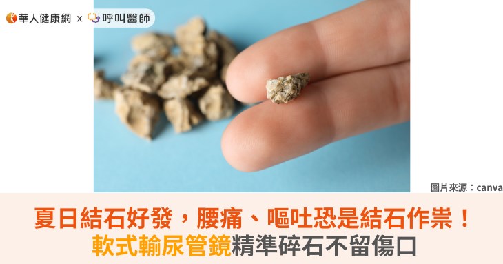 夏日結石好發,腰痛、嘔吐恐是結石作祟!軟式輸尿管鏡精準碎石不留傷口