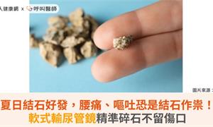 夏日結石好發，腰痛、嘔吐恐是結石作祟！軟式輸尿管鏡精準碎石不留傷口