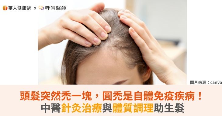 頭髮突然禿一塊,圓禿是自體免疫疾病!中醫針灸治療與體質調理助生髮
