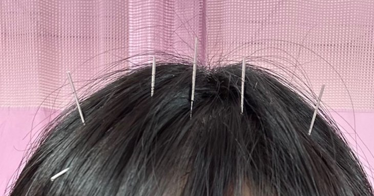 可搭配針灸治療,改善局部循環及整體身體狀態。(圖片提供/蔡和熹醫師)