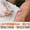 傷口久治不癒隱藏元凶：傷口生物膜！4步驟傷口照護，降低生物膜再生