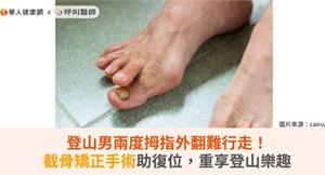 登山男兩度拇指外翻難行走！截骨矯正手術助復位，重享登山樂趣